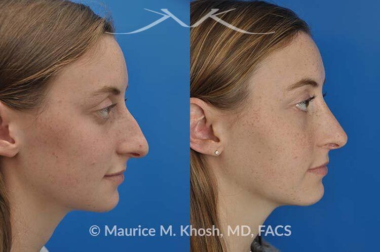 Droopy tip New York, NY