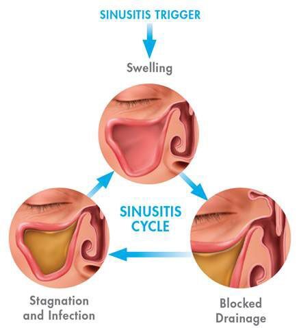 Chart showing sinusitis cycle. Swelling Bloked Drainage and stagnation and infection
