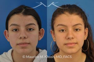 Photo of a patient before and after a procedure. Otoplasty - ear set back for protruding ears.