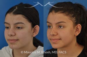 Photo of a patient before and after a procedure. Otoplasty - ear set back for protruding ears.