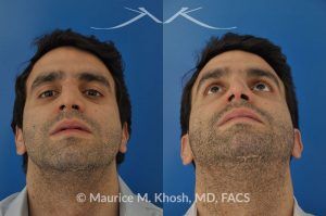 Photo of a patient before and after a procedure. Closed reduction of nose fracture, re-setting a proken nose as an office procedure - before and after results.