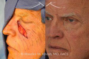 Photo of a patient before and after a procedure. Repair of melanoma excision defect in the cheek - before and after results.
