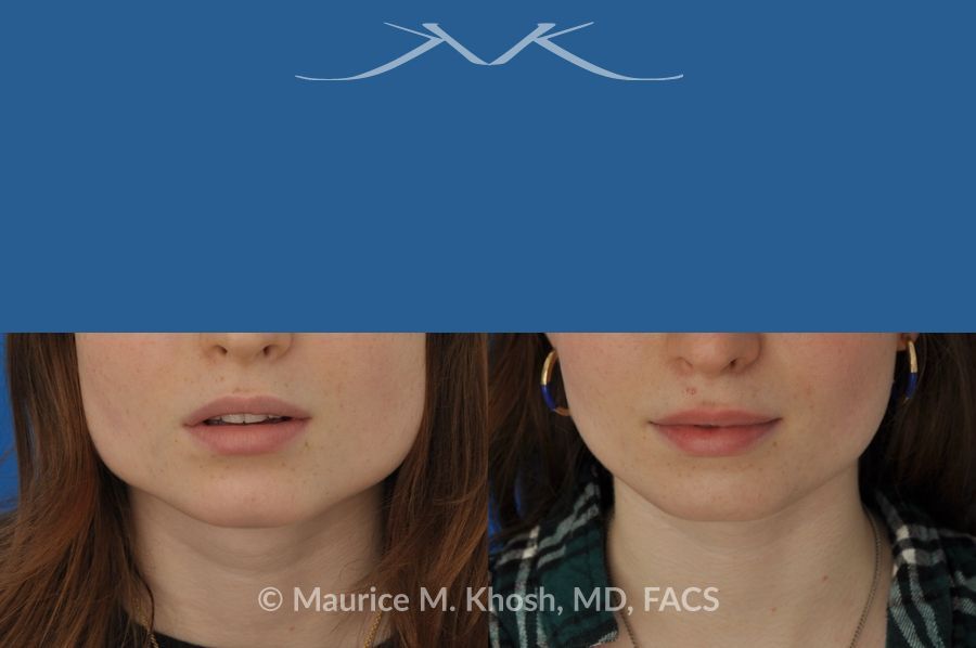 A man's face with a blue strip of eyes - Botox For Masseter Reduction