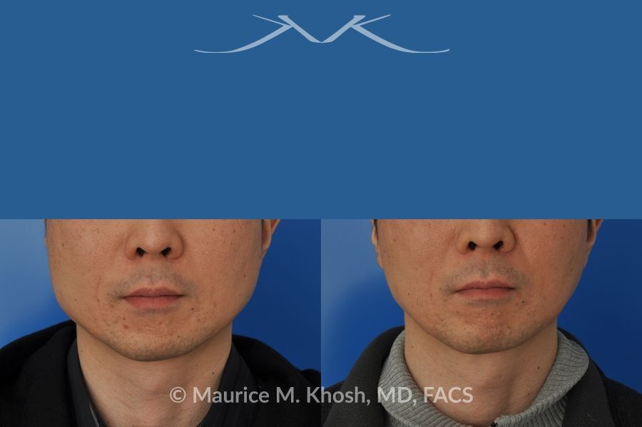 A man's face with a blue strip of eyes - Botox For Masseter Reduction