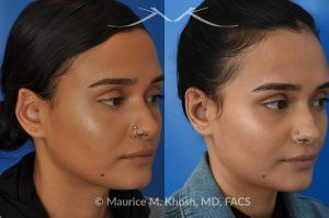 Photo of a patient before and after a procedure. Reconstruction of Upper Ear Collapse After Piercing Infection - 26 year old had developed upper ear infection and collapse following a piercing gone wrong. Cartilage from another part of the ear was used to rebuild the upper rim of the external ear