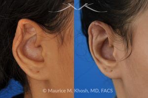 Photo of a patient before and after a procedure. Reconstruction of Upper Ear Collapse After Piercing Infection - 26 year old had developed upper ear infection and collapse following a piercing gone wrong. Cartilage from another part of the ear was used to rebuild the upper rim of the external ear