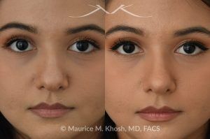 Photo of a patient before and after a procedure. Female patient before and after Liquid rhinoplasty - Liquid rhinoplasty in NYC for subtle improvement of the nasal tip and the bridge of the nose using facial fillers. Precise placement of minimal amounts of facial filler into the bridge of the nose and the nasal tip allowed our delightful patient to achieve a smooth nasal profile and a more proportioned and slightly elevated nasal tip. 
