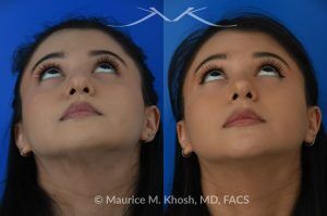 Photo of a patient before and after a procedure. Female patient before and after Liquid rhinoplasty - Liquid rhinoplasty in NYC for subtle improvement of the nasal tip and the bridge of the nose using facial fillers. Precise placement of minimal amounts of facial filler into the bridge of the nose and the nasal tip allowed our delightful patient to achieve a smooth nasal profile and a more proportioned and slightly elevated nasal tip. 
