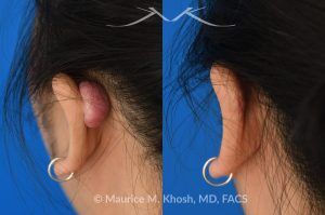 Photo of a patient before and after a procedure. Ear Keloid - before and after treatment results.