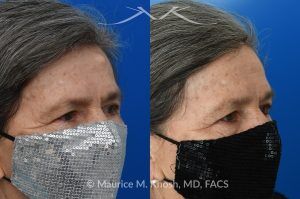 Photo of a patient before and after a procedure. Forehead Osteoma Removal - before-and-after composite photo.