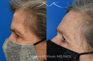 Photo of a patient before and after a procedure. Forehead Osteoma Removal - before-and-after composite photo.
