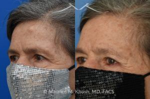 Photo of a patient before and after a procedure. Forehead Osteoma Removal - before-and-after composite photo.