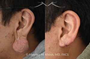 Photo of a patient before and after a procedure. Large Hanging Keloid of Earlobe - before and after treatment results.