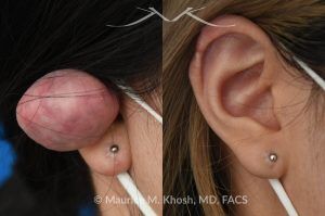 Photo of a patient before and after a procedure. Dense Keloid of Right Upper Ear - before and after treatment results.