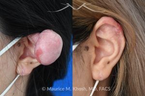 Photo of a patient before and after a procedure. Dense Keloid of Right Upper Ear - before and after treatment results.