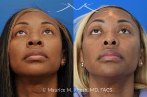 Photo of a patient before and after a procedure. Rhinoplasty to narrow nostrils and bridge of nose, neck liposuction - before and after results.