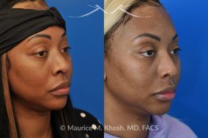 Photo of a patient before and after a procedure. Rhinoplasty to narrow nostrils and bridge of nose, neck liposuction - before and after results.