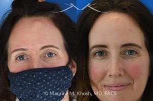 Photo of a patient before and after a procedure. Forehead Osteoma Removal Under Local Anesthesia - This 43 year old sought treatment for forehead osteoma in our New York office. She had the osteoma present for 20 years. The osteoma removal was performed in the office under local anesthesia. 

