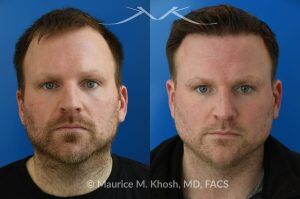 Photo of a patient before and after a procedure. FUE Hair Transplant for Receding Hairline - This 36 year old man requested hair restoration for receding hairline.  A follicular extraction transplant (FUE) procedure allowed transplantation of 1800 follicles from the back of the head to the frontal and temporal region of the scalp. The photo shows his one year post transplant results. He is ecstatic with his results.