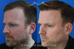 Photo of a patient before and after a procedure. FUE Hair Transplant for Receding Hairline - This 36 year old man requested hair restoration for receding hairline.  A follicular extraction transplant (FUE) procedure allowed transplantation of 1800 follicles from the back of the head to the frontal and temporal region of the scalp. The photo shows his one year post transplant results. He is ecstatic with his results.
