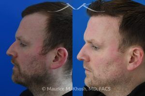 Photo of a patient before and after a procedure. FUE Hair Transplant for Receding Hairline - This 36 year old man requested hair restoration for receding hairline.  A follicular extraction transplant (FUE) procedure allowed transplantation of 1800 follicles from the back of the head to the frontal and temporal region of the scalp. The photo shows his one year post transplant results. He is ecstatic with his results.