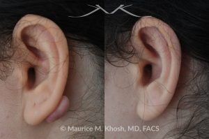 Photo of a patient before and after a procedure. Keloid Scar on Back of Right Earlobe - before and after treatment results.