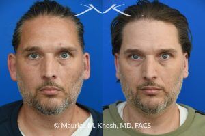 Photo of a patient before and after a procedure. Otoplasty (Ear Pinning) to Correct Over-Projected Ears - This gentleman was interested in ear pinning to correct over-projected ears. He underwent otoplasty under local anesthesia in our Manhattan office. He is delighted with the improved shape of his ears. 