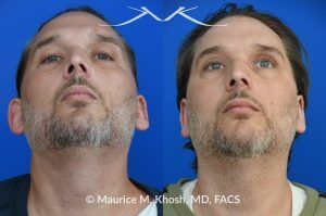 Photo of a patient before and after a procedure. Otoplasty (Ear Pinning) to Correct Over-Projected Ears - This gentleman was interested in ear pinning to correct over-projected ears. He underwent otoplasty under local anesthesia in our Manhattan office. He is delighted with the improved shape of his ears. 