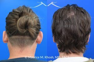 Photo of a patient before and after a procedure. Otoplasty (Ear Pinning) to Correct Over-Projected Ears - This gentleman was interested in ear pinning to correct over-projected ears. He underwent otoplasty under local anesthesia in our Manhattan office. He is delighted with the improved shape of his ears. 