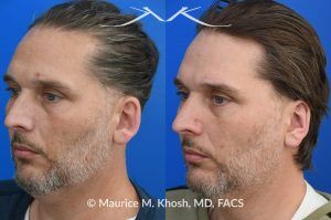 Photo of a patient before and after a procedure. Otoplasty (Ear Pinning) to Correct Over-Projected Ears - This gentleman was interested in ear pinning to correct over-projected ears. He underwent otoplasty under local anesthesia in our Manhattan office. He is delighted with the improved shape of his ears. 