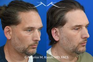Photo of a patient before and after a procedure. Otoplasty (Ear Pinning) to Correct Over-Projected Ears - This gentleman was interested in ear pinning to correct over-projected ears. He underwent otoplasty under local anesthesia in our Manhattan office. He is delighted with the improved shape of his ears. 