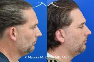 Photo of a patient before and after a procedure. Otoplasty (Ear Pinning) to Correct Over-Projected Ears - This gentleman was interested in ear pinning to correct over-projected ears. He underwent otoplasty under local anesthesia in our Manhattan office. He is delighted with the improved shape of his ears. 