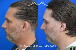 Photo of a patient before and after a procedure. Otoplasty (Ear Pinning) to Correct Over-Projected Ears - This gentleman was interested in ear pinning to correct over-projected ears. He underwent otoplasty under local anesthesia in our Manhattan office. He is delighted with the improved shape of his ears. 