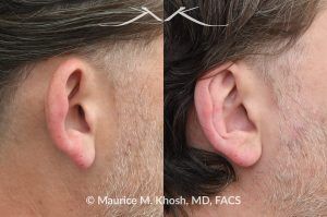 Photo of a patient before and after a procedure. Otoplasty (Ear Pinning) to Correct Over-Projected Ears - This gentleman was interested in ear pinning to correct over-projected ears. He underwent otoplasty under local anesthesia in our Manhattan office. He is delighted with the improved shape of his ears. 