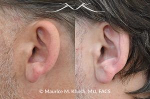 Photo of a patient before and after a procedure. Otoplasty (Ear Pinning) to Correct Over-Projected Ears - This gentleman was interested in ear pinning to correct over-projected ears. He underwent otoplasty under local anesthesia in our Manhattan office. He is delighted with the improved shape of his ears. 