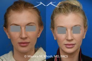 Photo of a patient before and after a procedure. Otoplasty - before-and-after composite photo.