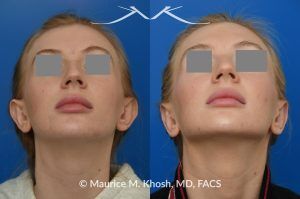 Photo of a patient before and after a procedure. Otoplasty - before-and-after composite photo.