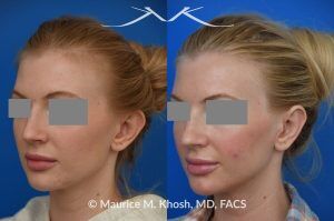 Photo of a patient before and after a procedure. Otoplasty - before-and-after composite photo.