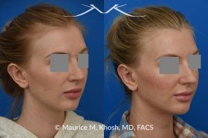 Photo of a patient before and after a procedure. Otoplasty - before-and-after composite photo.