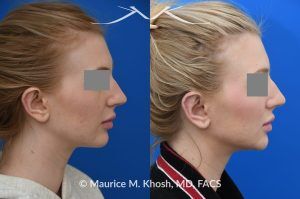 Photo of a patient before and after a procedure. Otoplasty - before-and-after composite photo.