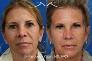 Photo of a patient before and after a procedure. Secondary repair of Moh's defect to corrent nostril retraction - before and after photos.