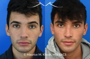 Photo of a patient before and after a procedure. Revision rhinoplasty for scooped appearing nose - This young patient has previously undergone rhinoplasty, which resulted in an over-resected nasal bridge with a 'scooped slope'. He wanted revision rhinoplasty to restore the natural height and contour to the bridge of his nose. He also wanted to reduce the nasal tip rotation. We used his septal cartilage and ear cartilage to restore the nose. He is ecstatic with his results. 