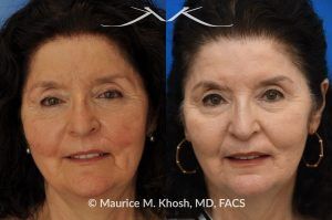 Photo of a patient before and after a procedure. In Office Lip Scar Revision Improved Appearance - This patient had suffered an injury to her lip, which was repaired in the emergency room. She disliked the obvious and raised appearance of the scar. Scar revision surgery as an in-office procedure allowed us to make the scar almost invisible. 