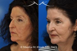 Photo of a patient before and after a procedure. In Office Lip Scar Revision Improved Appearance - This patient had suffered an injury to her lip, which was repaired in the emergency room. She disliked the obvious and raised appearance of the scar. Scar revision surgery as an in-office procedure allowed us to make the scar almost invisible. 