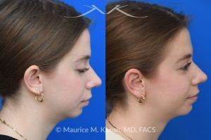 Photo of a patient before and after a procedure. Otoplasty - This young person wished to improve the  'floppy appearing ears'. She had been self conscious in wearing her hair back or exposing her ears. Ear pinning surgery, otoplasty, was performed in our Manhattan office under local anesthesia. She is delighted with the outcome of her otoplasty surgery.