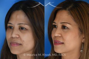 Photo of a patient before and after a procedure. Central Forehead Osteoma Removal Under Local Anesthesia - Central forehead osteoma was removed through an invisible 1cm incision in the hairline. The osteoma removal was performed in the office under local anesthesia in our Manhattan office