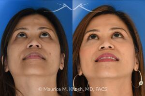 Photo of a patient before and after a procedure. Central Forehead Osteoma Removal Under Local Anesthesia - Central forehead osteoma was removed through an invisible 1cm incision in the hairline. The osteoma removal was performed in the office under local anesthesia in our Manhattan office