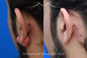 Photo of a patient before and after a procedure. Left Earlobe Keloid Excision - Left earlobe keloid excision performed in the office under local anesthesia. 
