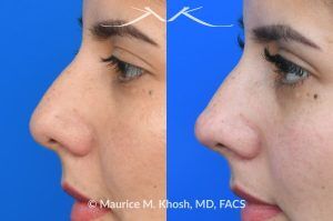 Photo of a patient before and after a procedure. Liquid rhinoplasty - Female patient before and after Liquid rhinoplasty.