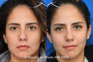 Photo of a patient before and after a procedure. Liquid rhinoplasty - Female patient before and after Liquid rhinoplasty.